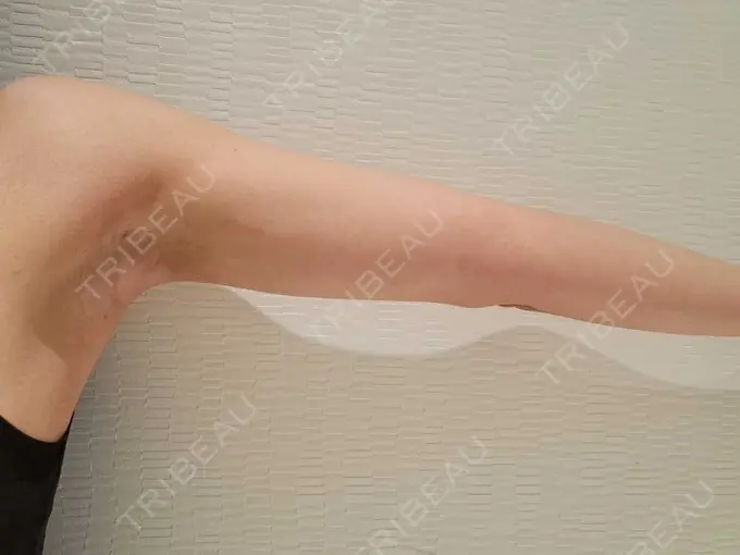 クマ治療 / 脂肪吸引（顔） / 脂肪吸引（二の腕） / 脂肪吸引（肩） / 脂肪注入（目の下） Mods Clinic（モッズクリニック） 名古屋院 DAY 90 メイン用