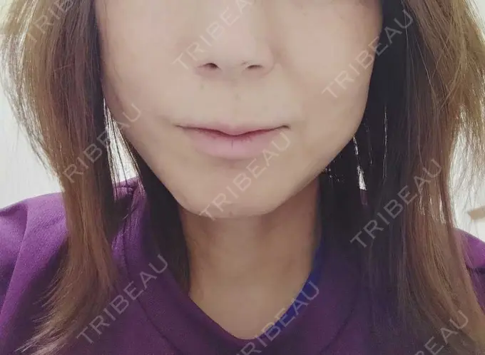 糸リフト / ボトックス（エラ・小顔） / ピーリング（ハリ・ツヤ） アリエル美容クリニック 横浜院 DAY 15 メイン用