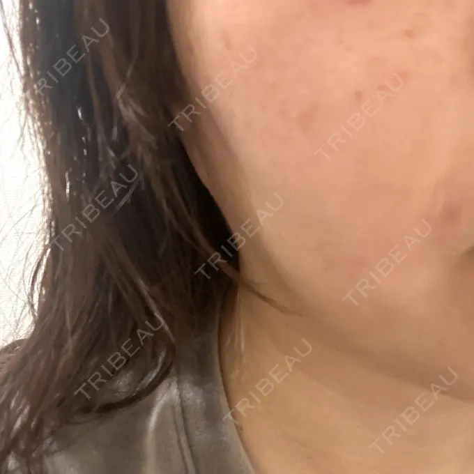 ボトックス（あご） / ピーリング（ニキビ・毛穴） / ルメッカ ルラ美容クリニック 大阪心斎橋院 AFTER メイン用