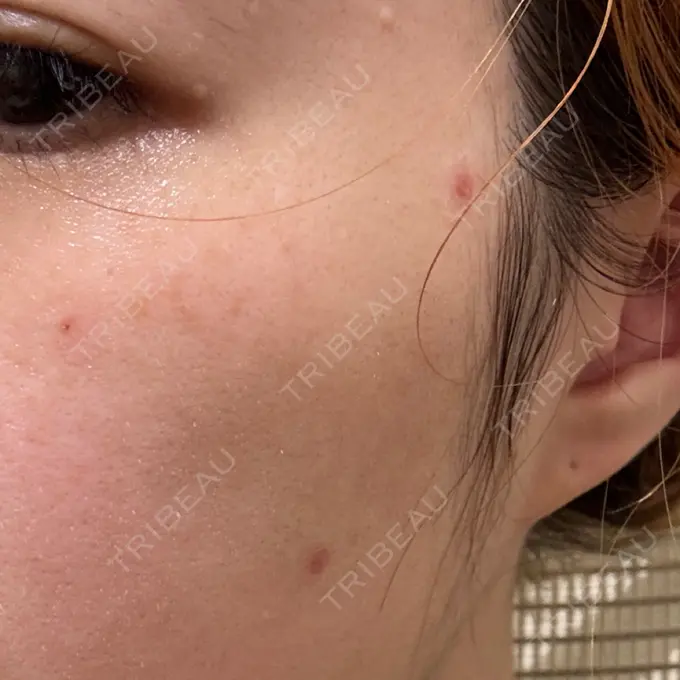 ほくろ・いぼ除去レーザー（肌） Mavie Beauty Clinic （マヴィービューティークリニック） DAY 4 メイン用