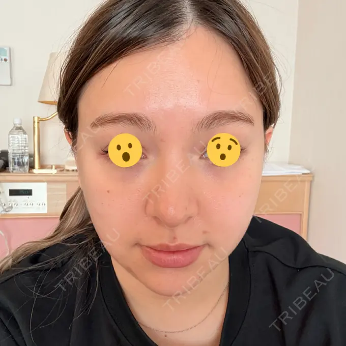 糸リフト / ヒアルロン酸注入（目の下） / RF（高周波）たるみ治療 gift clinic DAY 4 メイン用