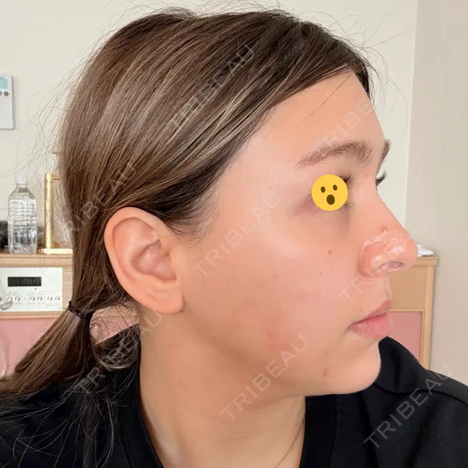 糸リフト / ヒアルロン酸注入（目の下） / RF（高周波）たるみ治療 gift clinic DAY 4 メイン用