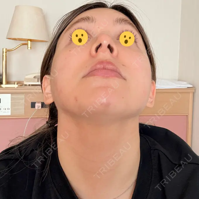 糸リフト / ヒアルロン酸注入（目の下） / RF（高周波）たるみ治療 gift clinic DAY 4 メイン用