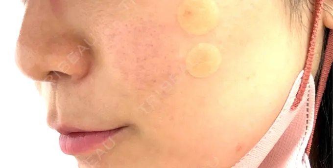 サブシジョン コスメディカルクリニック シンシア 渋谷院 AFTER メイン用