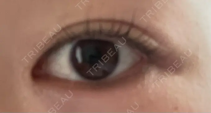 目頭切開 東京シンデレラ美容外科 池袋院 AFTER メイン用