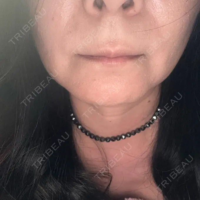 肌育注射（ジュベルックなど） Natural Skin Clinic 自由ヶ丘院 DAY 5 メイン用