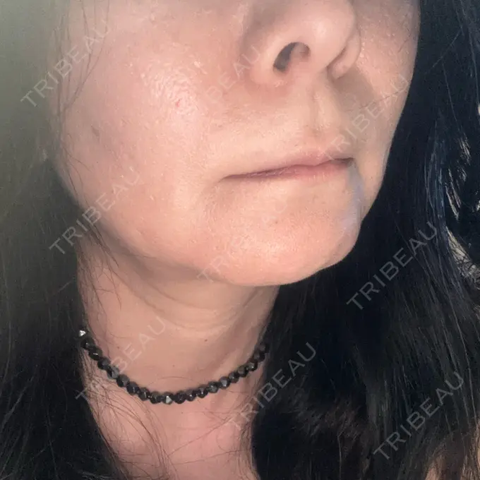 肌育注射（ジュベルックなど） Natural Skin Clinic 自由ヶ丘院 DAY 5 メイン用