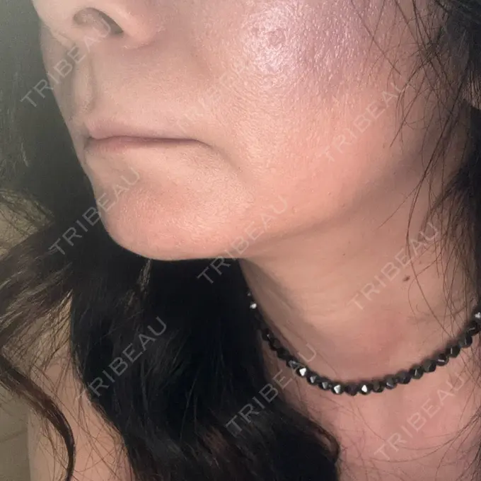 肌育注射（ジュベルックなど） Natural Skin Clinic 自由ヶ丘院 DAY 5 メイン用