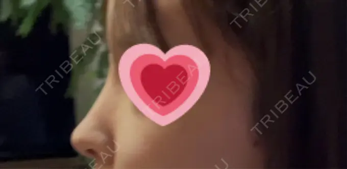 軟骨移植 吉祥寺アイビークリニック DAY 10 メイン用