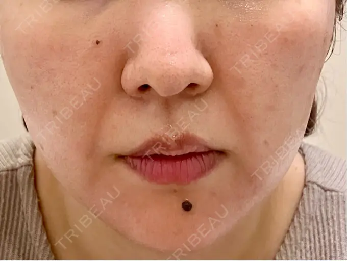 ピーリング（ニキビ・毛穴） / ピコレーザートーニング（美白・肝斑） / フラクショナルレーザー（毛穴・ニキビ跡） / ピコスポット BISIN GINZA CLINIC DAY 0 メイン用