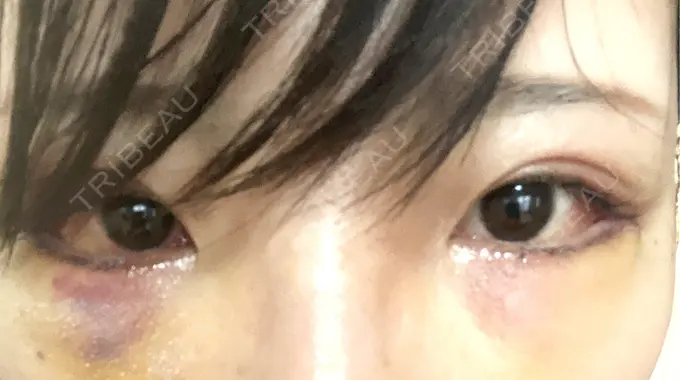 タレ目形成・グラマラスライン（切開） アリエル美容クリニック 横浜院 DAY 4 メイン用