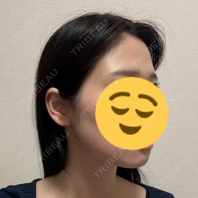 ボトックス（エラ・小顔） / RF（高周波）たるみ治療 大美会クリニック 梅田院 DAY 0 メイン用