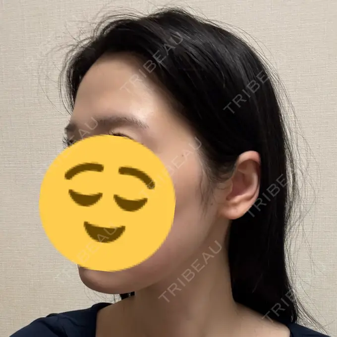 ボトックス（エラ・小顔） / RF（高周波）たるみ治療 大美会クリニック 梅田院 DAY 0 メイン用