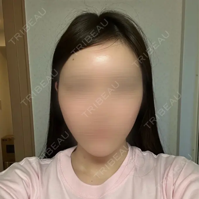 糸リフト 東京シンデレラ美容外科 池袋院 DAY 1 メイン用