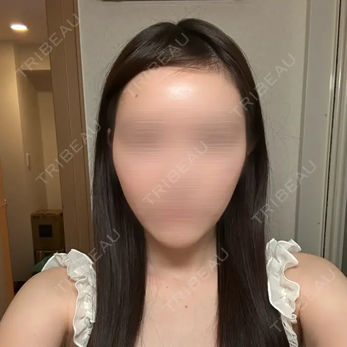 糸リフト 東京シンデレラ美容外科 池袋院 DAY 4 メイン用