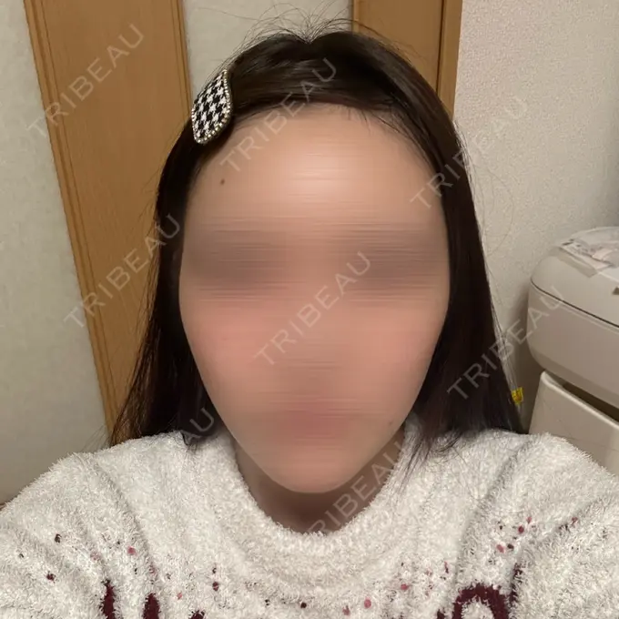 糸リフト 東京シンデレラ美容外科 池袋院 DAY 6 メイン用