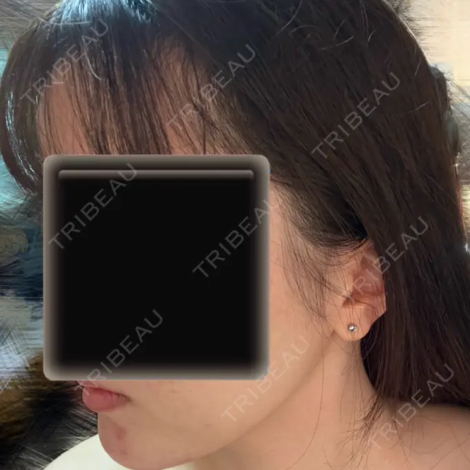 脂肪吸引（顔） Mods Clinic（モッズクリニック） 名古屋院 DAY 190 メイン用