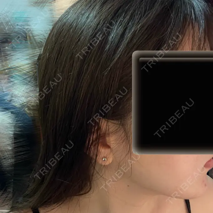 脂肪吸引（顔） Mods Clinic（モッズクリニック） 名古屋院 DAY 190 メイン用