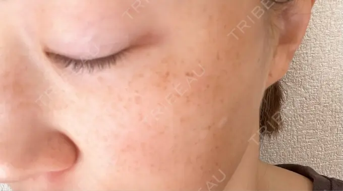 光治療（フォトフェイシャルなど） 城本クリニック 大宮院 DAY 1 メイン用