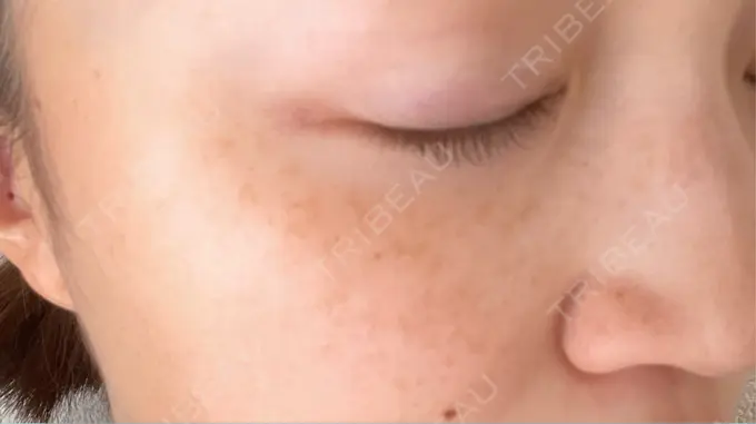 光治療（フォトフェイシャルなど） 城本クリニック 大宮院 DAY 1 メイン用