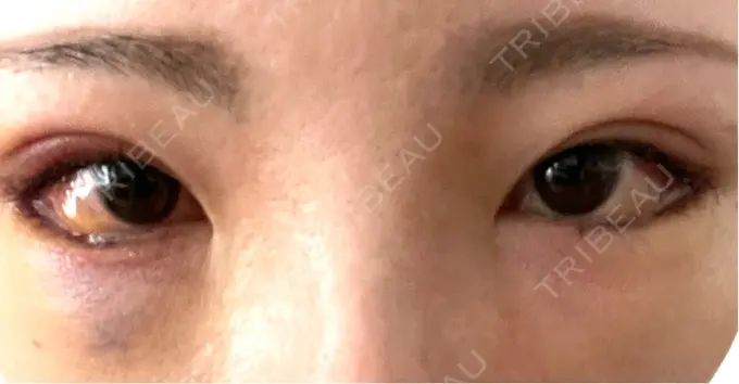 タレ目形成・グラマラスライン（切開） アリエル美容クリニック 横浜院 DAY 5 メイン用