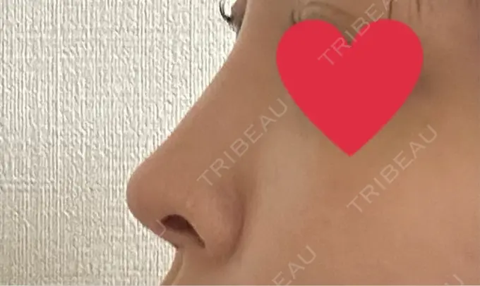 軟骨移植 吉祥寺アイビークリニック DAY 12 メイン用