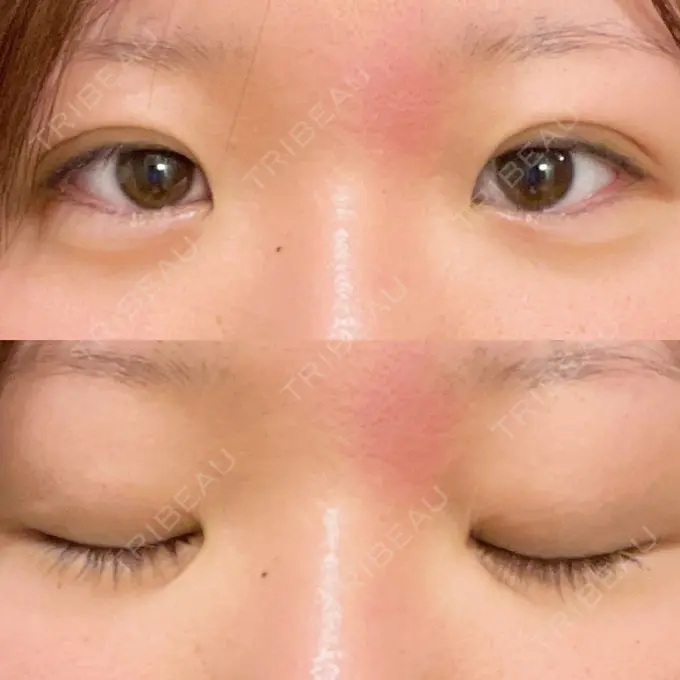 二重埋没 / ヒアルロン酸注入（涙袋） アリエル美容クリニック 横浜院 DAY 6 メイン用