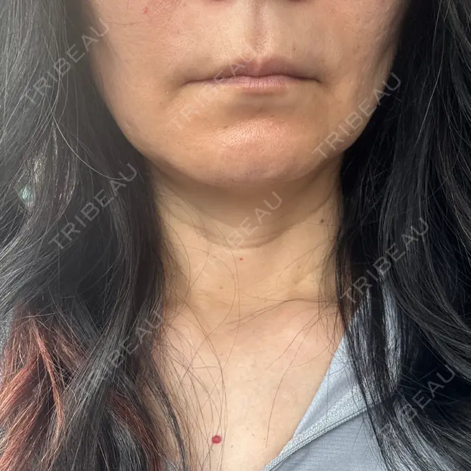 肌育注射（ジュベルックなど） Natural Skin Clinic 自由ヶ丘院 DAY 7 メイン用