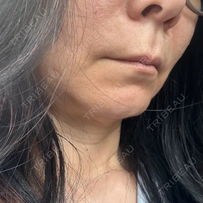 肌育注射（ジュベルックなど） Natural Skin Clinic 自由ヶ丘院 DAY 7 メイン用