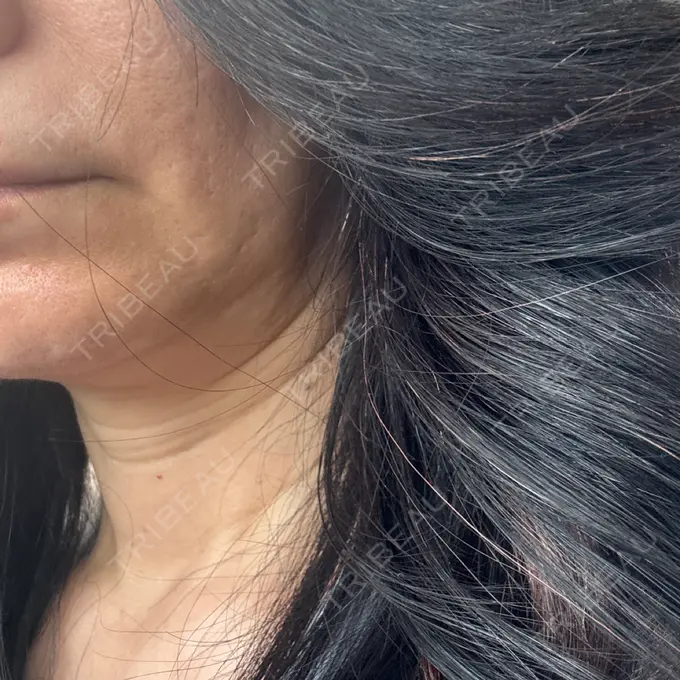 肌育注射（ジュベルックなど） Natural Skin Clinic 自由ヶ丘院 DAY 7 メイン用