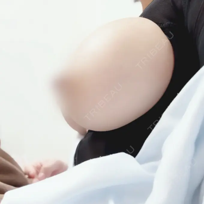 豊胸（シリコンバッグ） ルーチェクリニック 銀座院 DAY 7 メイン用