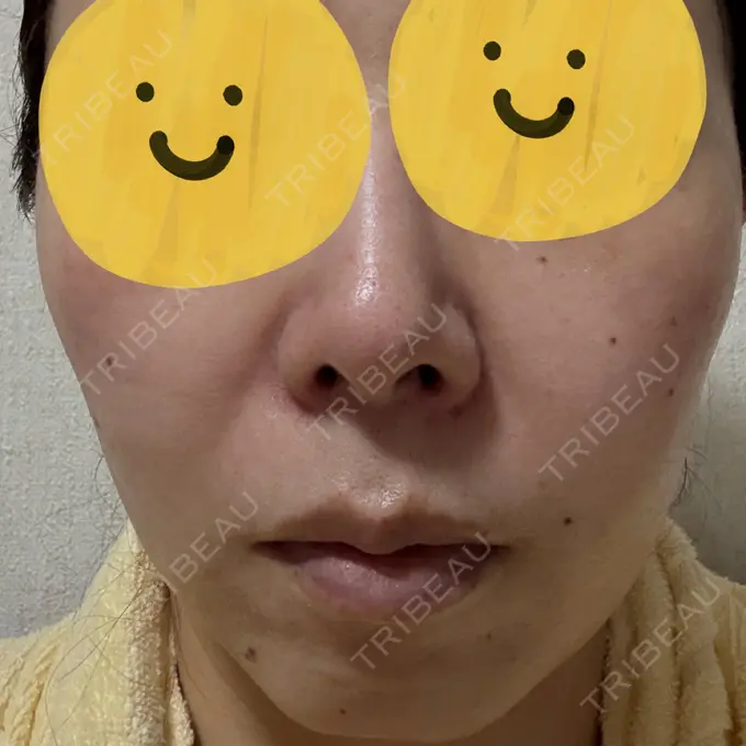 リジュラン しんゆり美容健康クリニック AFTER メイン用