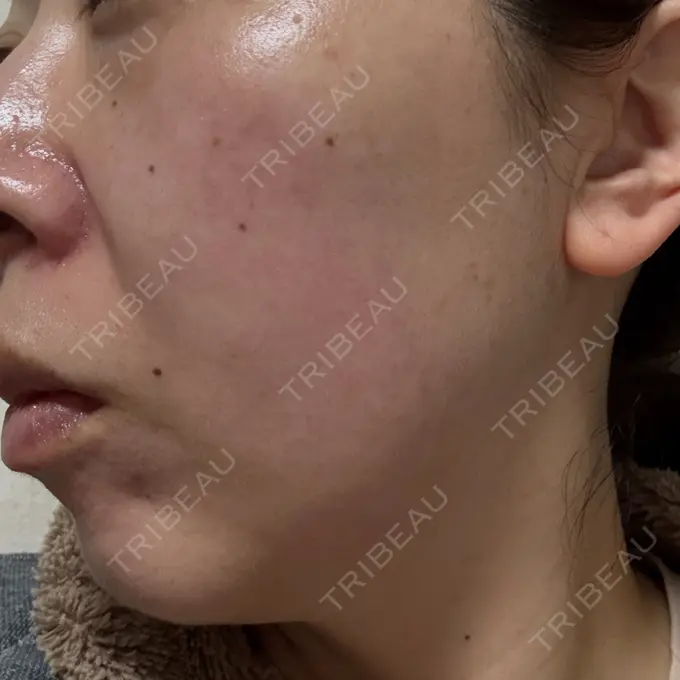 リジュラン しんゆり美容健康クリニック DAY 7 メイン用