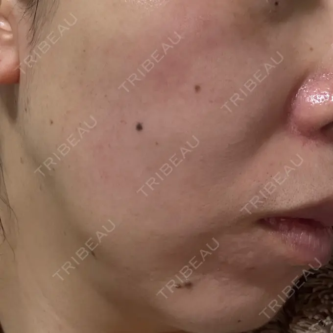 リジュラン しんゆり美容健康クリニック DAY 7 メイン用