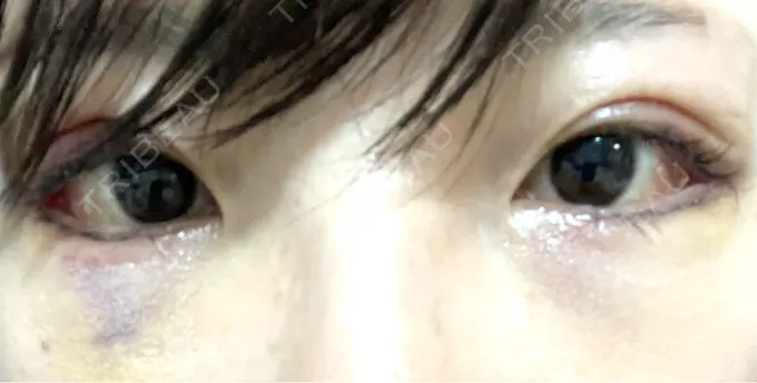 タレ目形成・グラマラスライン（切開） アリエル美容クリニック 横浜院 DAY 6 メイン用