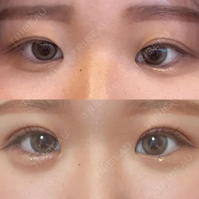 二重埋没 / ヒアルロン酸注入（涙袋） アリエル美容クリニック 横浜院 DAY 7 メイン用