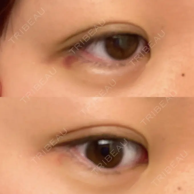 二重埋没 / ヒアルロン酸注入（涙袋） アリエル美容クリニック 横浜院 DAY 7 メイン用