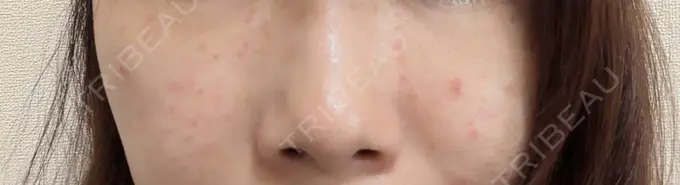 ニードルRF（ポテンツァなど） KM新宿クリニック DAY 1 メイン用