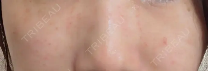 ニードルRF（ポテンツァなど） KM新宿クリニック DAY 2 メイン用