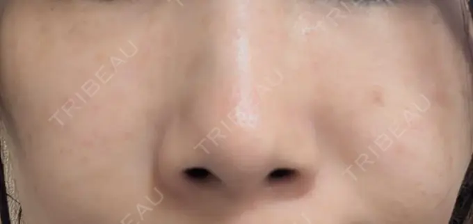 ニードルRF（ポテンツァなど） KM新宿クリニック AFTER メイン用