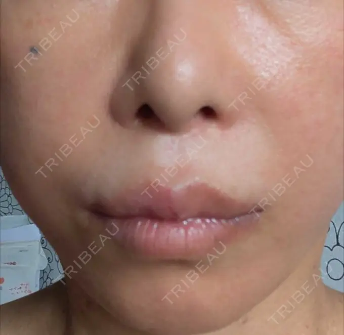 アートメイク（唇） TRUE DESIGN CLINIC DAY 11 メイン用