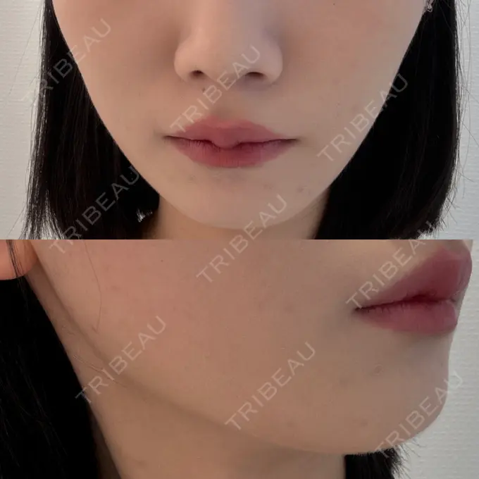 ボトックス（エラ・小顔） 東京シンデレラ美容外科 池袋院 DAY 0 メイン用