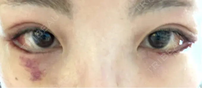 タレ目形成・グラマラスライン（切開） アリエル美容クリニック 横浜院 DAY 7 メイン用