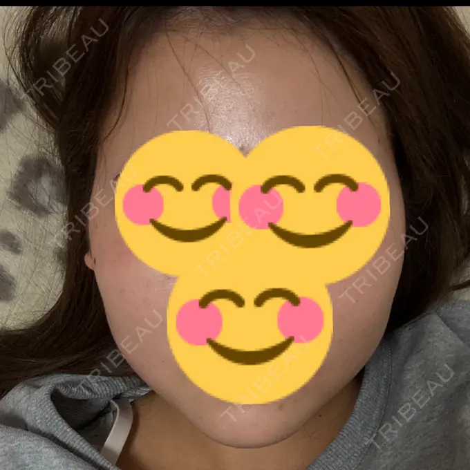 RF（高周波）たるみ治療 RIVER CLINIC（リバークリニック） AFTER メイン用