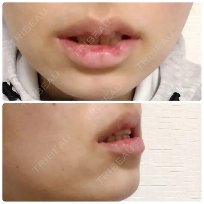 口唇縮小術 品川スキンクリニック表参道院 DAY 12 メイン用