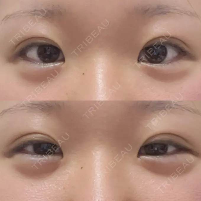 二重埋没 / ヒアルロン酸注入（涙袋） アリエル美容クリニック 横浜院 DAY 8 メイン用
