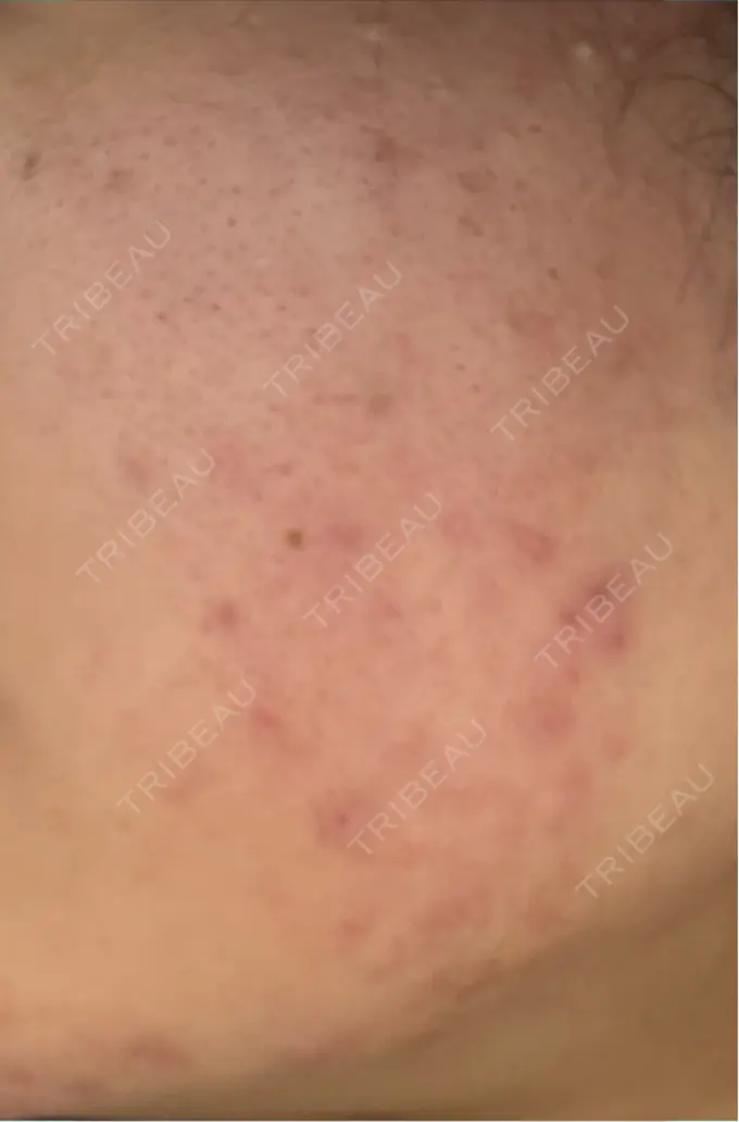 毛穴洗浄（ハイドラフェイシャルなど） / リジュラン 表参道ウィズ・クリニック DAY 0 メイン用