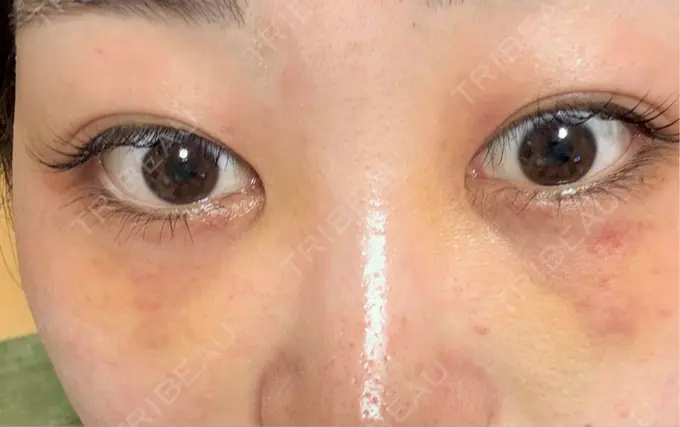 クマ治療 / ヒアルロン酸注入（目の下） 仙台N美容クリニック DAY 5 メイン用