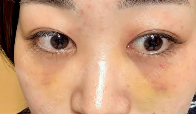 クマ治療 / ヒアルロン酸注入（目の下） 仙台N美容クリニック DAY 6 メイン用