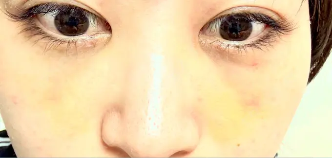 クマ治療 / ヒアルロン酸注入（目の下） 仙台N美容クリニック DAY 7 メイン用